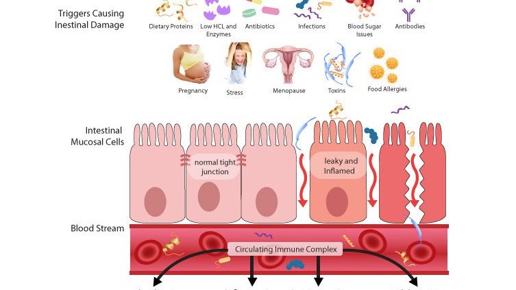 Leaky Gut