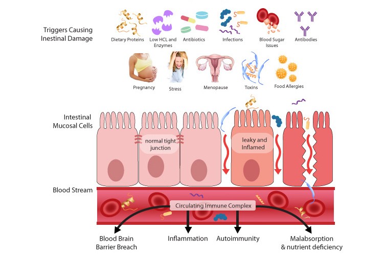 Leaky Gut