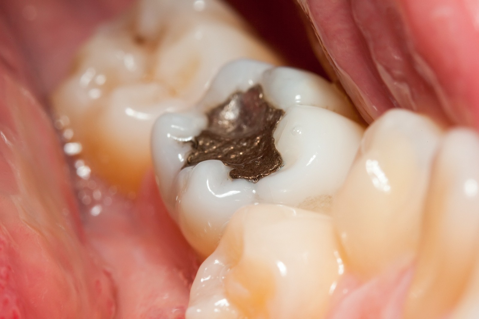 mercury toxicity